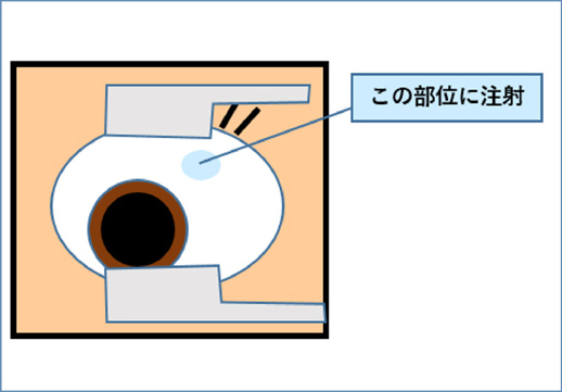 硝子体注射