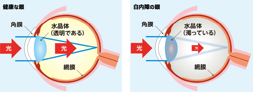 白内障説明図