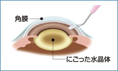 局所麻酔（点眼液）後、角膜に2.4mmの切開をします。水晶体を包んでいる袋を切開します。