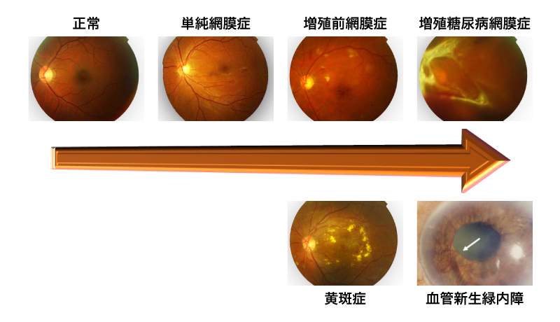 糖尿病網膜症説明図