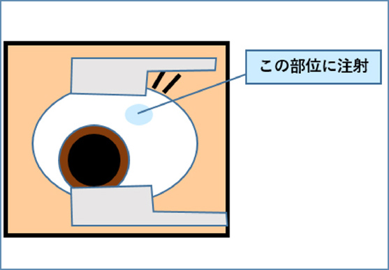 硝子体注射