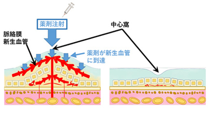 硝子体注射